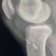 Tibial