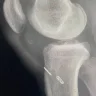 Tibial