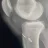 Tibial